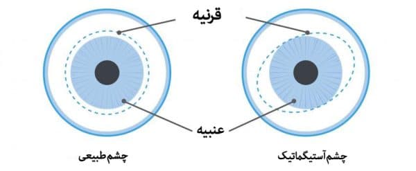 درمان آستیگماتیسم چشم بدون جراحی