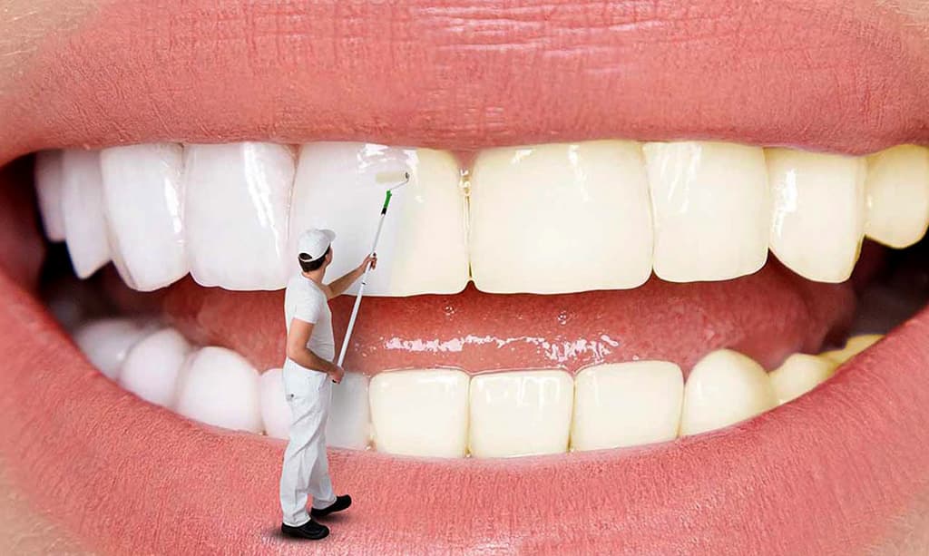 کسی بلیچینگ دندون رو با قیمت مناسب سراغ داره؟