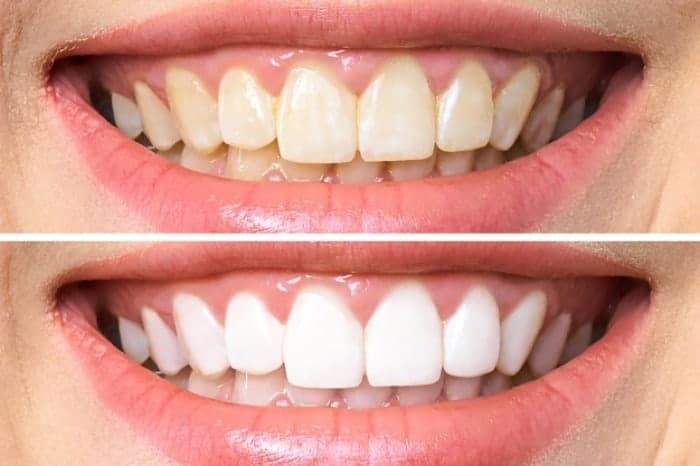 برای سفید کردن دندان چه روشی رو پیشنهاد میکنین؟