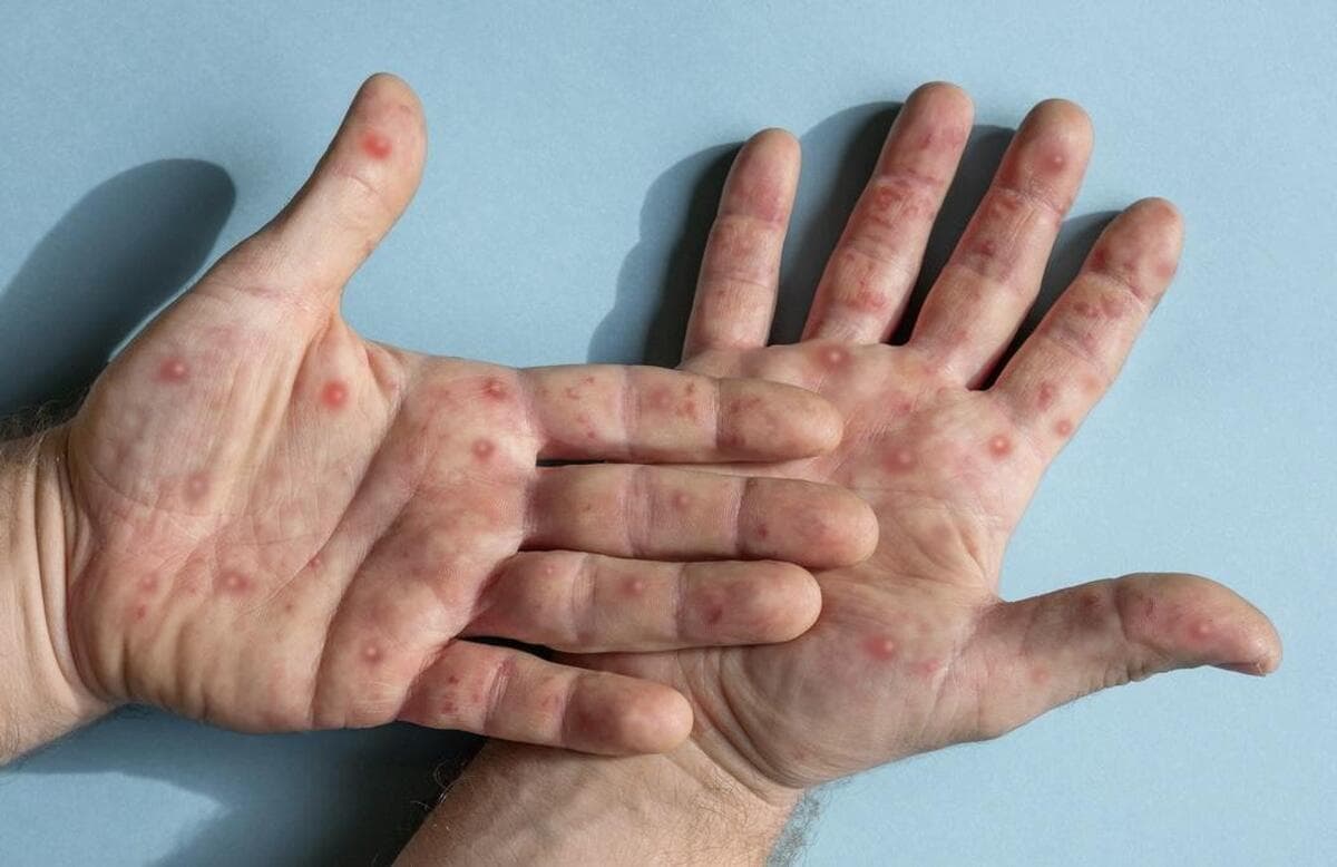 آیا آبله میمونی در حال شیوع است؟ میزان خطرناک بودن آن چقدر ارزیابی می‌شود؟ 