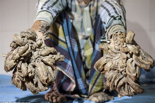 بیماری مرد درختی